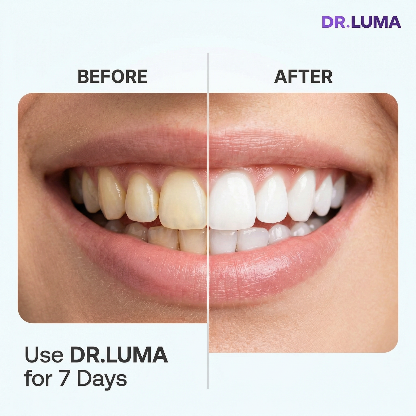 Purple Teeth Whitening Strips